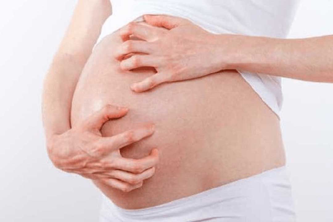 Severe Itching During Pregnancy