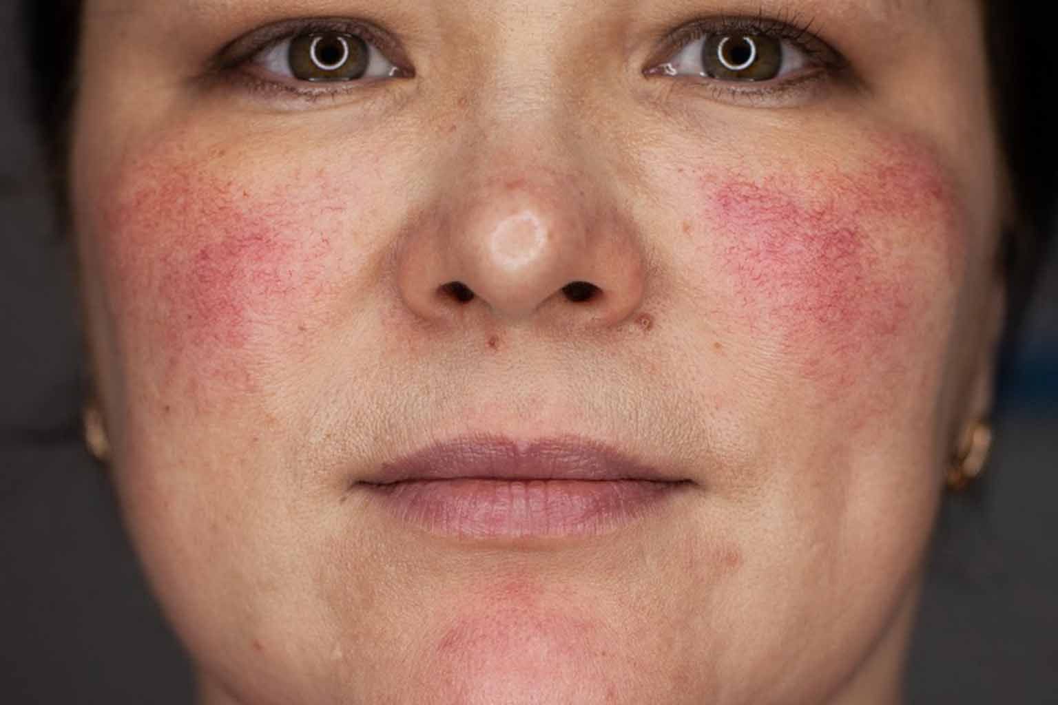 Hives