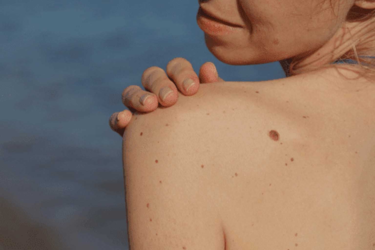 Skin Tags