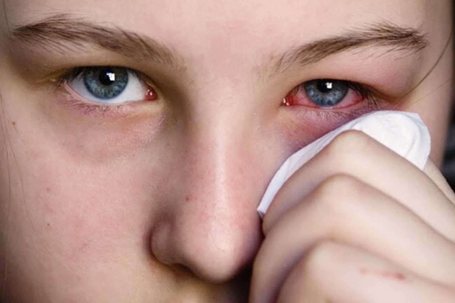 Pink Eye or Conjunctivitis