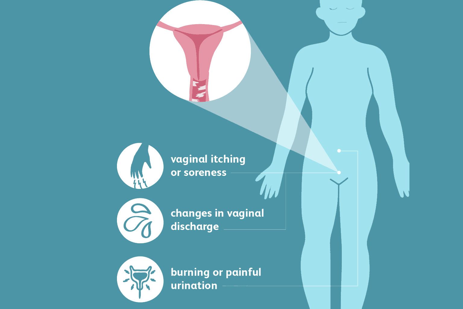 Causes Of White Discharge