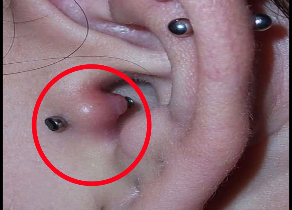 Infected Tragus Piercing Signs