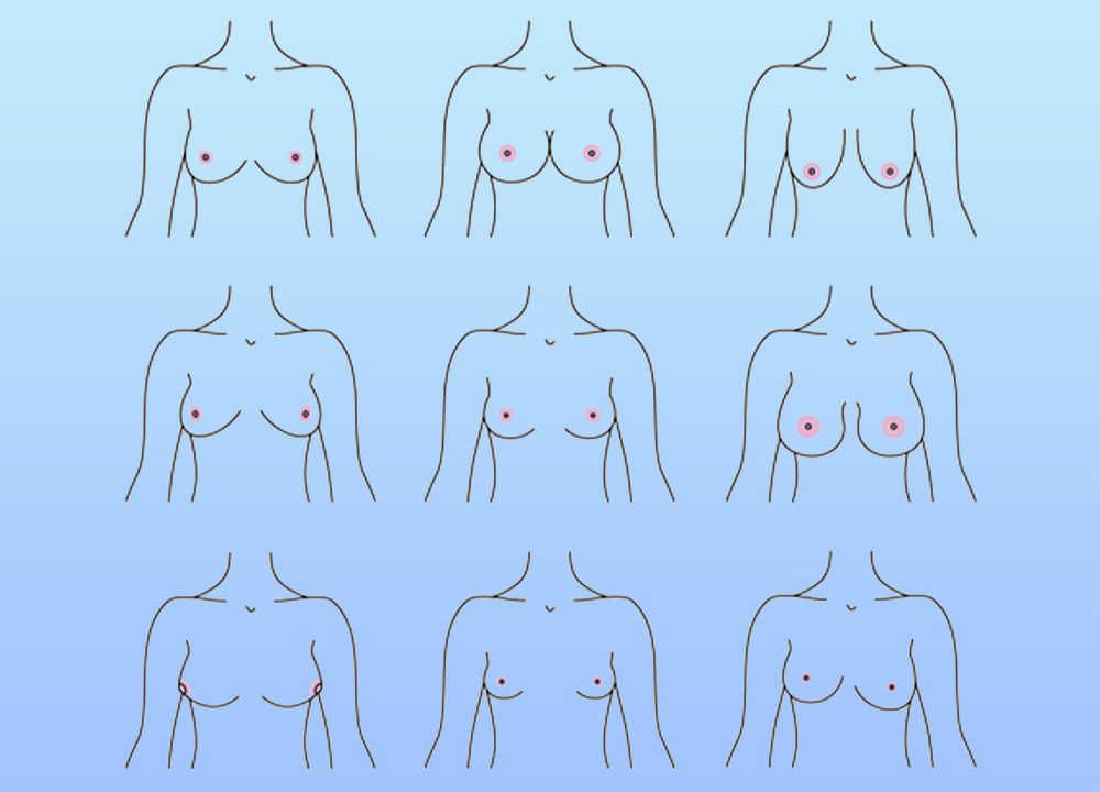 Breast Types