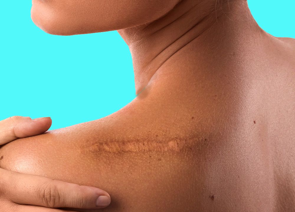 Preventing Scars After Surgery