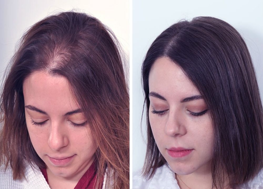 Hair Transplant