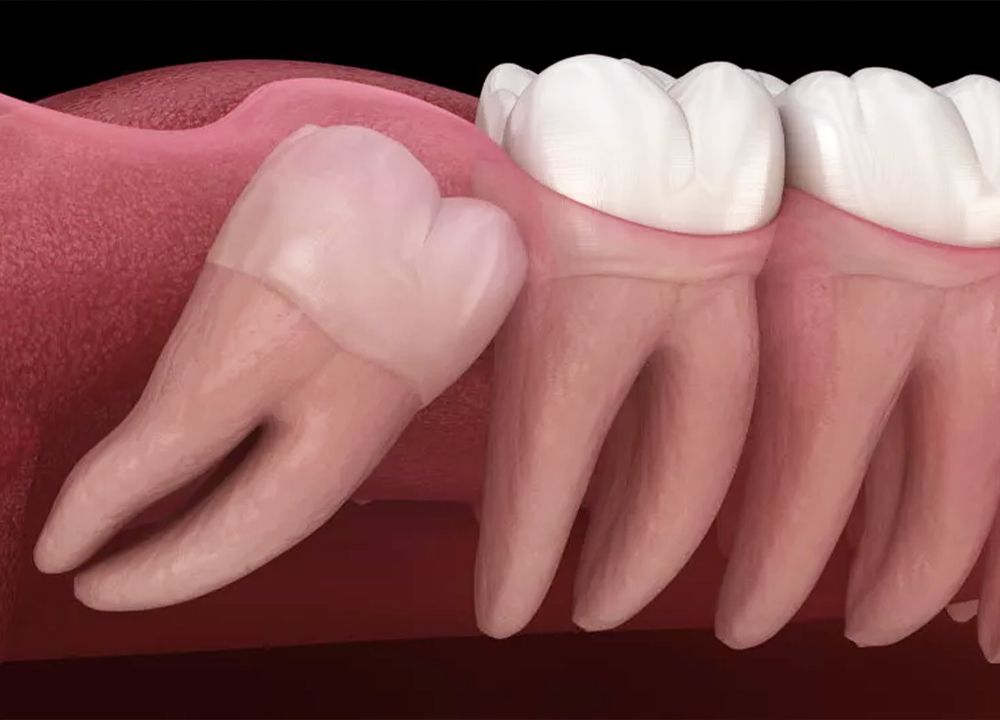 Impacted Wisdom Teeth